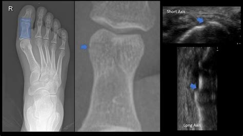 Proximal Phalanx Fracture Foot