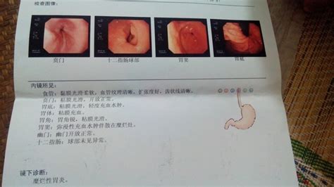 电子胃镜诊断报告单-解读电子胃镜检查报告单