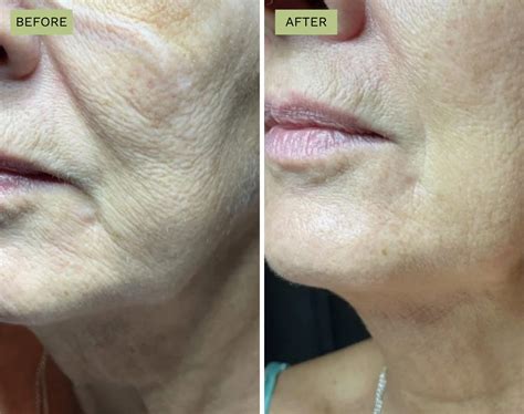 Image result for Cheek Threads