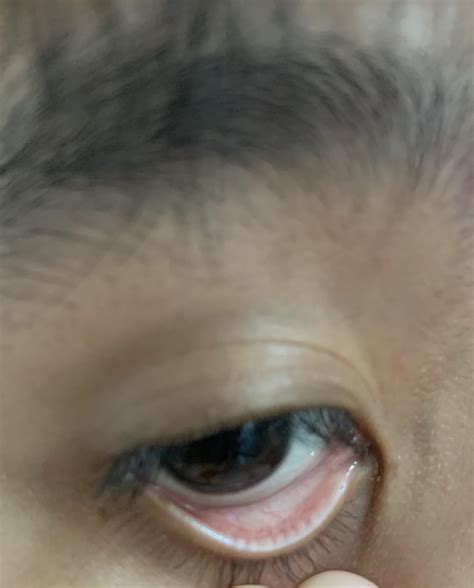 White Oil Glands On Face at Rosetta Cogan blog