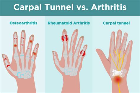 Carpal Tunnel Syndrome: Treatment & Relief | Aptiva Health