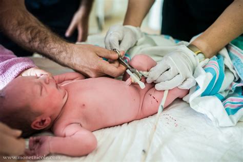 Bildergebnis für umbilical cord around neck complications