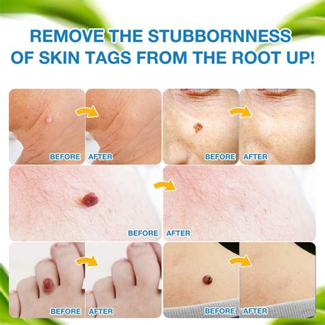 Ulensy Skin Tag Remover - Extra Strength Liquid for Fast, Pain-Free Skin Tag Removal - Natural ...