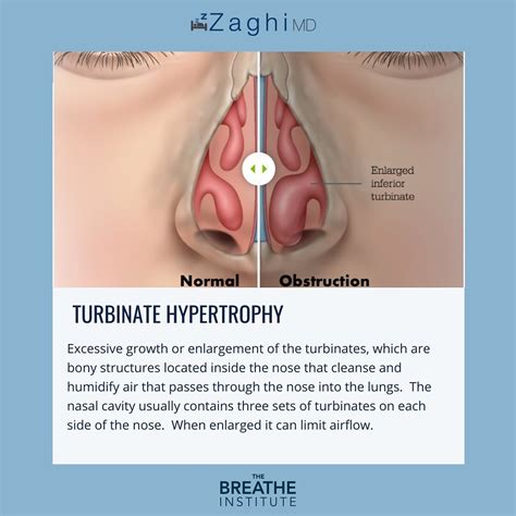 Nasal Turbinate Hypertrophy