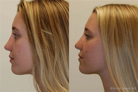 Eric M. Joseph, MD | Permanent Non Surgical Rhinoplasty/ Nose Job