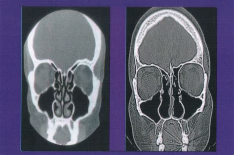 Nasal cripple syndrome: Like a plastic bag was over his head