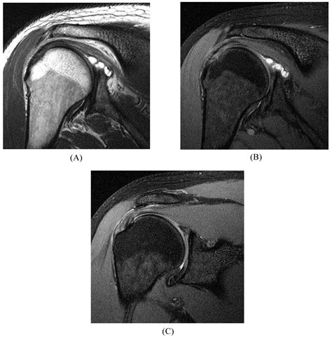 MR Imaging of SLAP Lesions