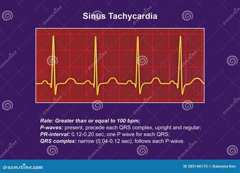 Electrocardiogram Displaying Sinus Tachycardia, 3D Illustration Stock Illustration ...