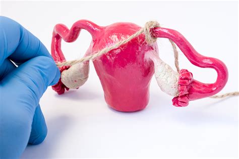 What is Post Tubal Ligation Syndrome (PTLS) - Female Sterilization Reversals