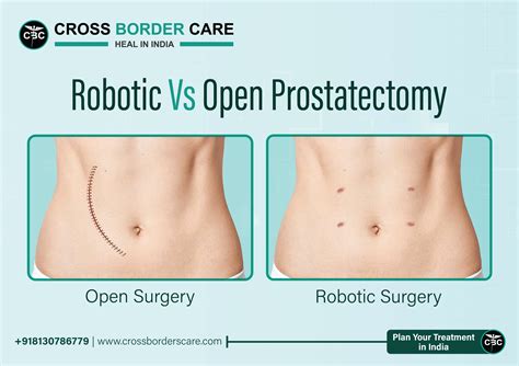 History Of Robotic Prostatectomy at Courtney Szeto blog