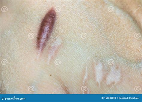 Keloid Scar Hypertrophic Scar on Man Hand Skin after Accident. Keloidal Scar on Wrist Skin Cause ...