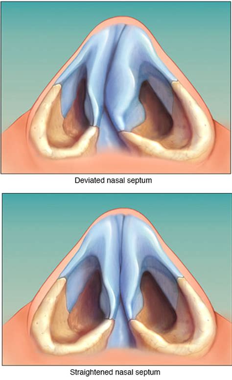 Septoplasty Surgery - Recovery Time & Complications