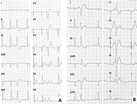 Premature Ventricular Contractions Couplet