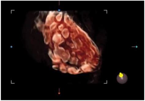 Ultrasound Assessment in Polycystic Ovary Syndrome Diagnosis: From Origins to Future ...