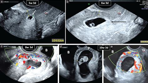 Ectopic Pregnancy Ultrasound Vs Normal Pregnancy