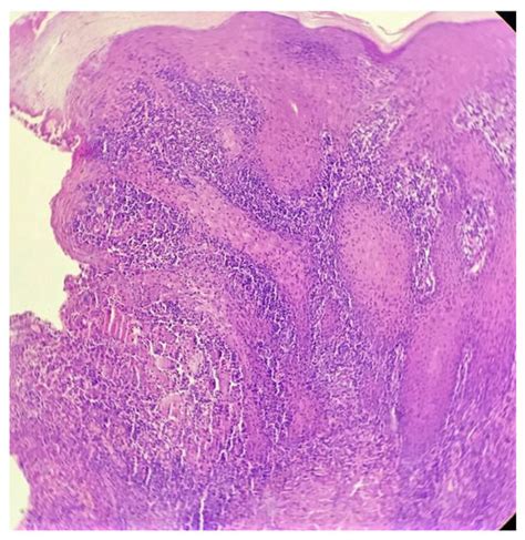 “Lichenoid Granulomatous Pattern” in a Case of Lupus Vulgaris