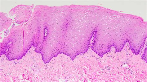 Pathology Outlines - Squamous metaplasia