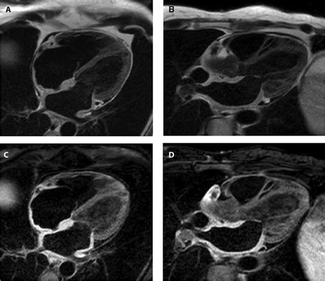 Atrial Giant Cell Myocarditis | Circulation