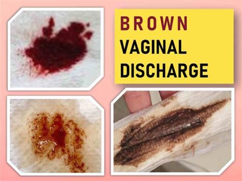 Brown Vaginal Discharge: Causes, Treatment, and When to get Tested ...