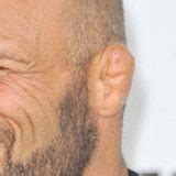 Bildergebnis für cauliflower ear before and after