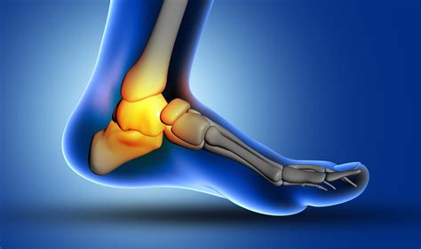 ¿Qué Es Un Esguince De Tobillo De Segundo Grado? – MCCBLX