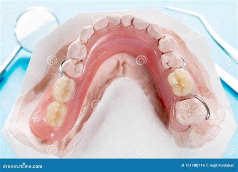 Artificial Removable Partial Denture. Stock Photo - Image of dentist ...