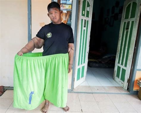 10-year-old Arya Permanente weighed over 190 kilograms. Now the boy is ...