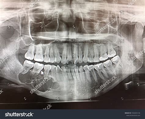Odontogenic Keratocyst Tumor
