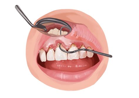 How Is Deep Cleaning Of Teeth Done at Antonio Fore blog