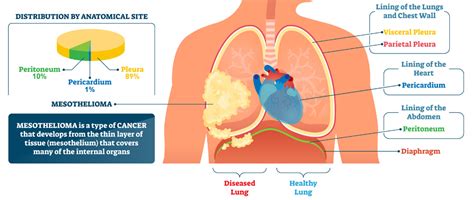 End Stage of Emphysema 的图像结果