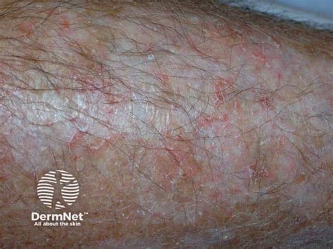 https://dermnetnz.org/assets/Uploads/dermatitis/eczema-craquele4.jpg