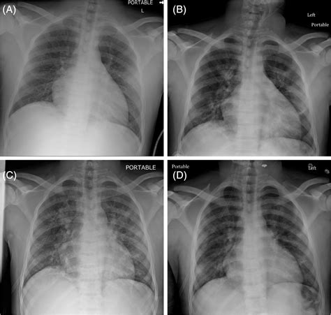 Acute Chest Syndrome Xray - Captions Profile