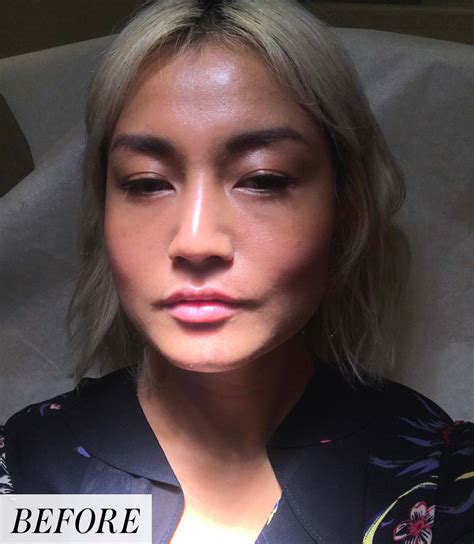 Bad Lip Injections Before And After