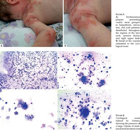 Nail Bed Infection In Newborn at Carrie Booker blog