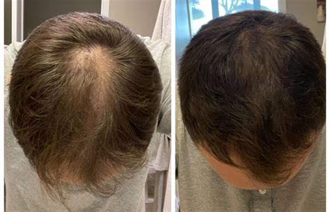 60-day progress with Minoxidil : r/tressless