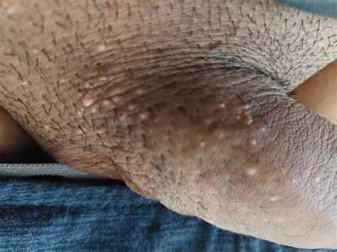 ¿Por Qué Aparecen Granos En El Pene? – VNUMS