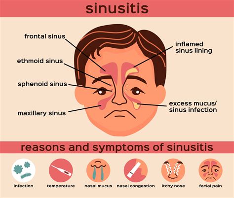 Bacterial Sinus Infection Symptoms
