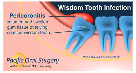 Signs Of Wisdom Teeth Growing