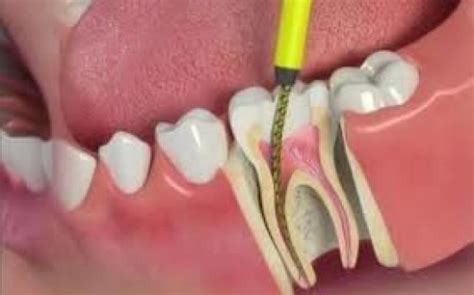 Root Canal Treatment - Ocean Dental - Best Dentist in Vadodara