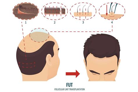 FUE vs. FUT Hair Transplant Harvesting - YouTube
