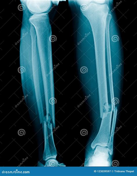 X-ray Fracture Leg Royalty-Free Stock Photo | CartoonDealer.com #123039597