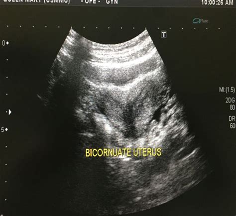 Didelphys Uterus Ultrasound