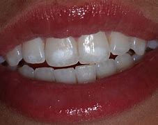 Image result for decalcification
