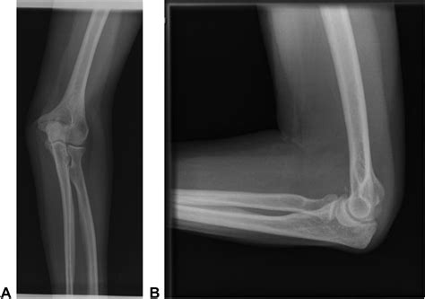 Perched Anteromedial Radial Head Dislocation - Journal of Hand Surgery ...