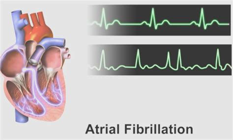 Metoprolol or diltiazem, which is better for rate control in atrial ...