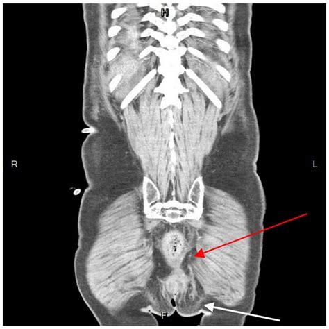 Ischiorectal Abscess Mri