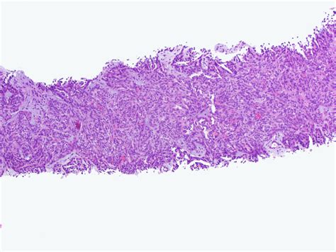 Pathology Outlines - Mucinous tubular and spindle cell carcinoma