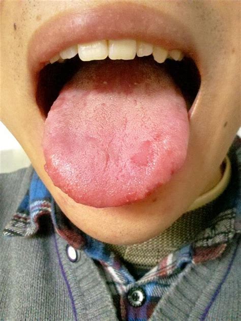 舌头红有齿痕 舌两边有齿痕怎么办?_第二人生