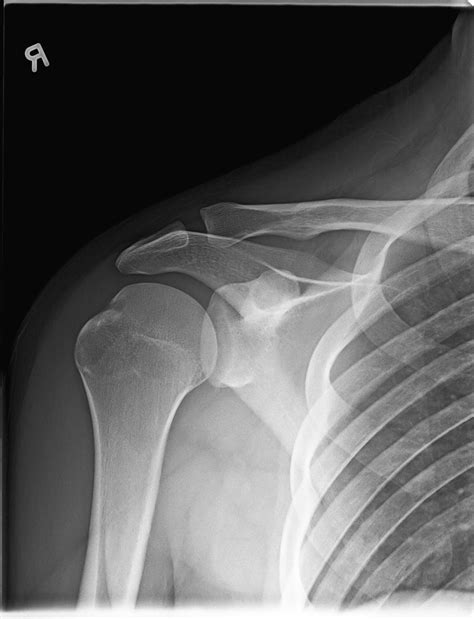 Shoulder Xray Normal