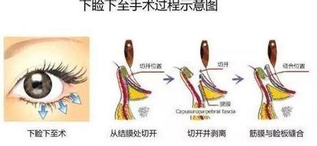 眼睑皮肤松弛没神采？双眼皮+开眼角手术来重塑眼部魅力_千颜网